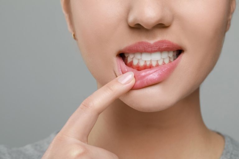 periodontitt